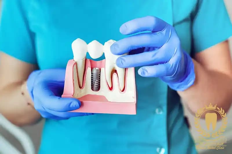 متخصص ایمپلنت دندان چه ویژگی دارد؟