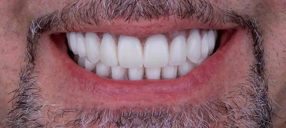 قبل و بعد ایمپلنت دندان چیست؟