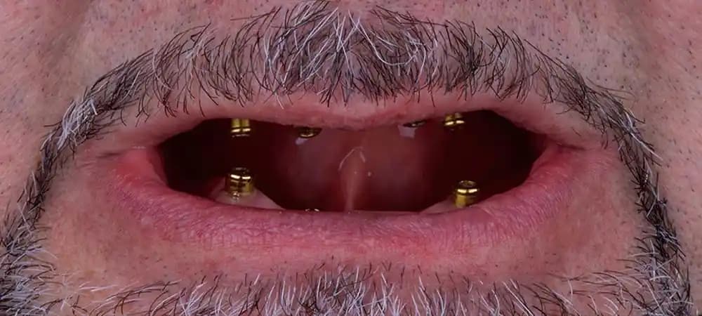 قبل و بعد ایمپلنت دندان چیست؟