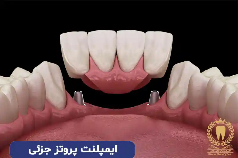 انواع روش های جایگزین کردن دندان از دست رفته