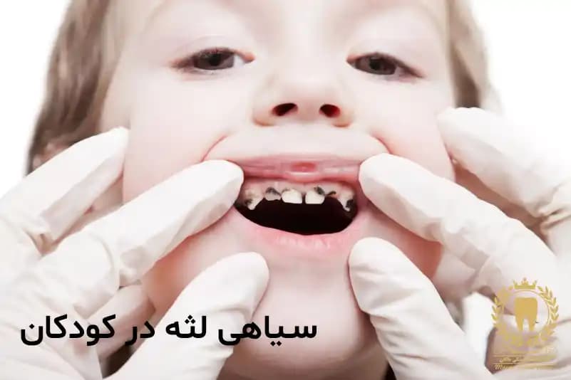 سیاهی لثه در کودکان