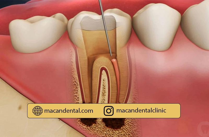 عصب کشی دندان (Root Canal)  چیست؟