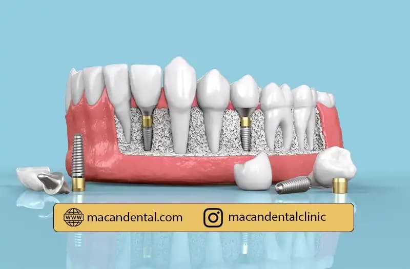 ایمپلنت دندان چیست؟