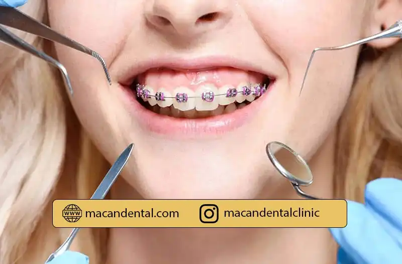 ارتودنسی دندان چیست؟ انواع روش‌ها، قیمت و مدت درمان