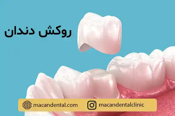 روکش دندان: درمانی برای زیبایی، استحکام و محافظت از دندان‌ها