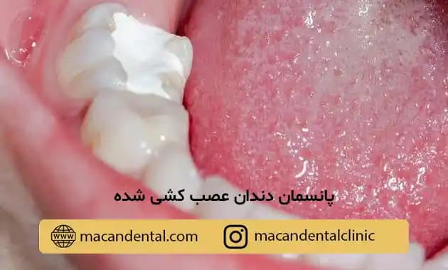 پانسمان دندان عصب کشی شده: انواع، اهمیت و مراقبت‌ پس از آن