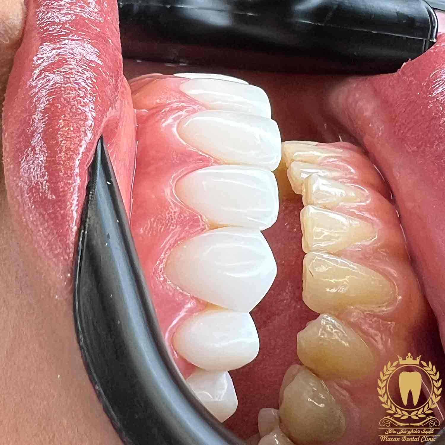 9 واحد لمینت کامپوزیتی آلمانی درجه یک IPS 9 واحد لمینت کامپوزیتی آلمانی درجه یک IPS