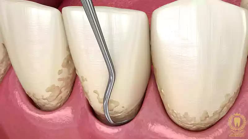 فرق جرمگیری لثه با جرم گیری دندان چیست؟ فرق جرمگیری لثه با جرم گیری دندان چیست؟
