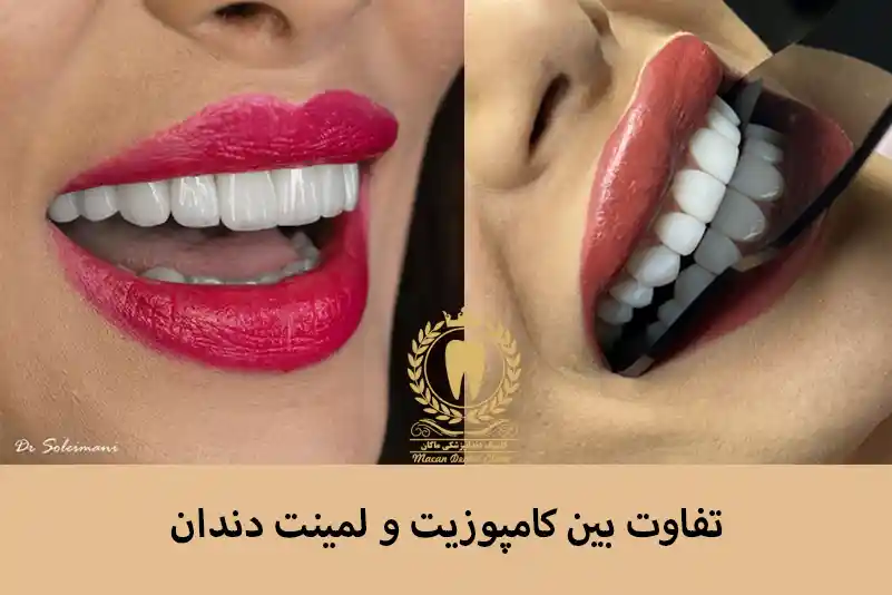 تفاوت لمینت و کامپوزیت دندان
