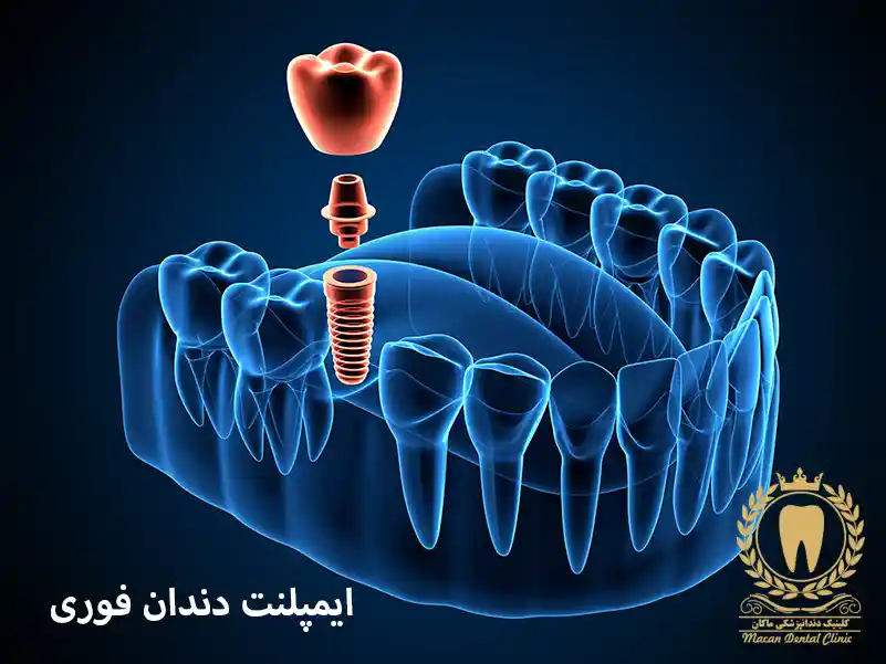 ایمپلنت فوری یا یک روزه