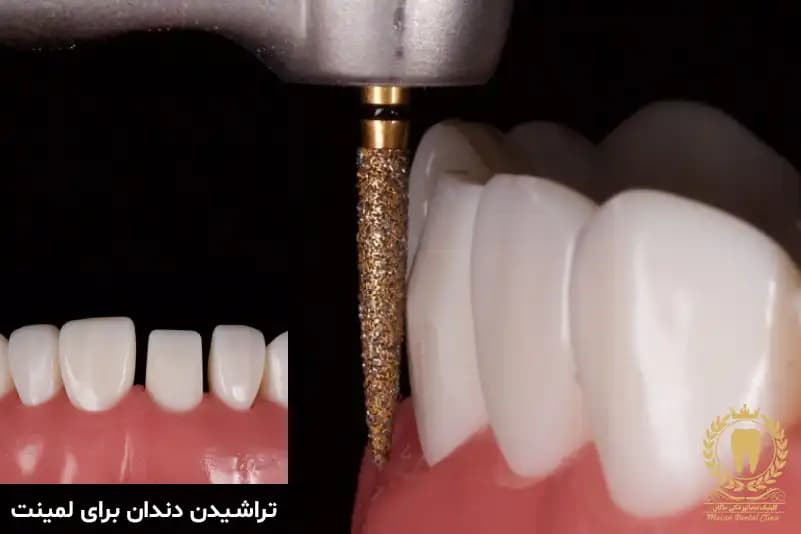 مقدار تراش دندان برای لمینت مقدار تراش دندان برای لمینت