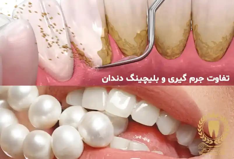 تفاوت جرم گیری و بلیچینگ دندان تفاوت جرم گیری و بلیچینگ دندان