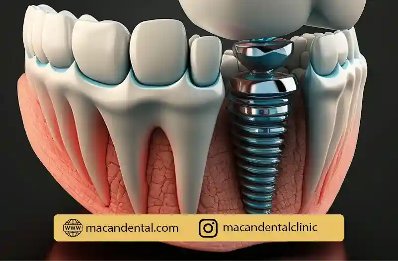 ایمپلنت دندان در تهران: راهی برای بازگشت به لبخند طبیعی