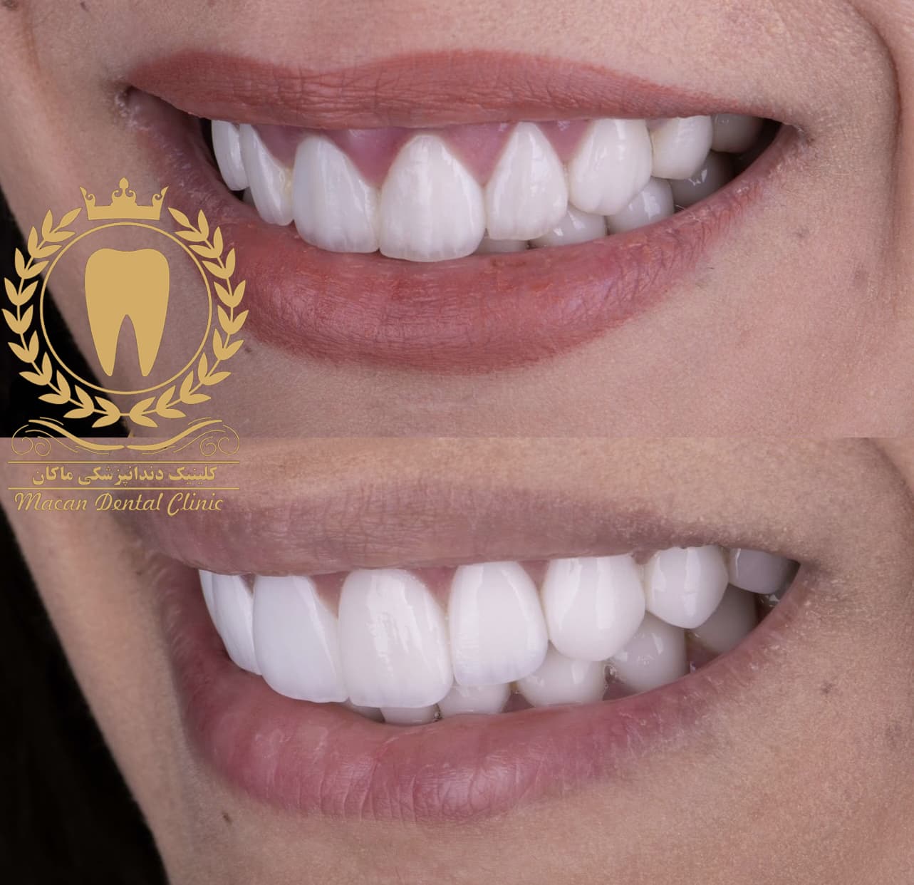 لمینت سرامیکی درجه یک IPS EMAX آلمانی لمینت سرامیکی درجه یک IPS EMAX آلمانی