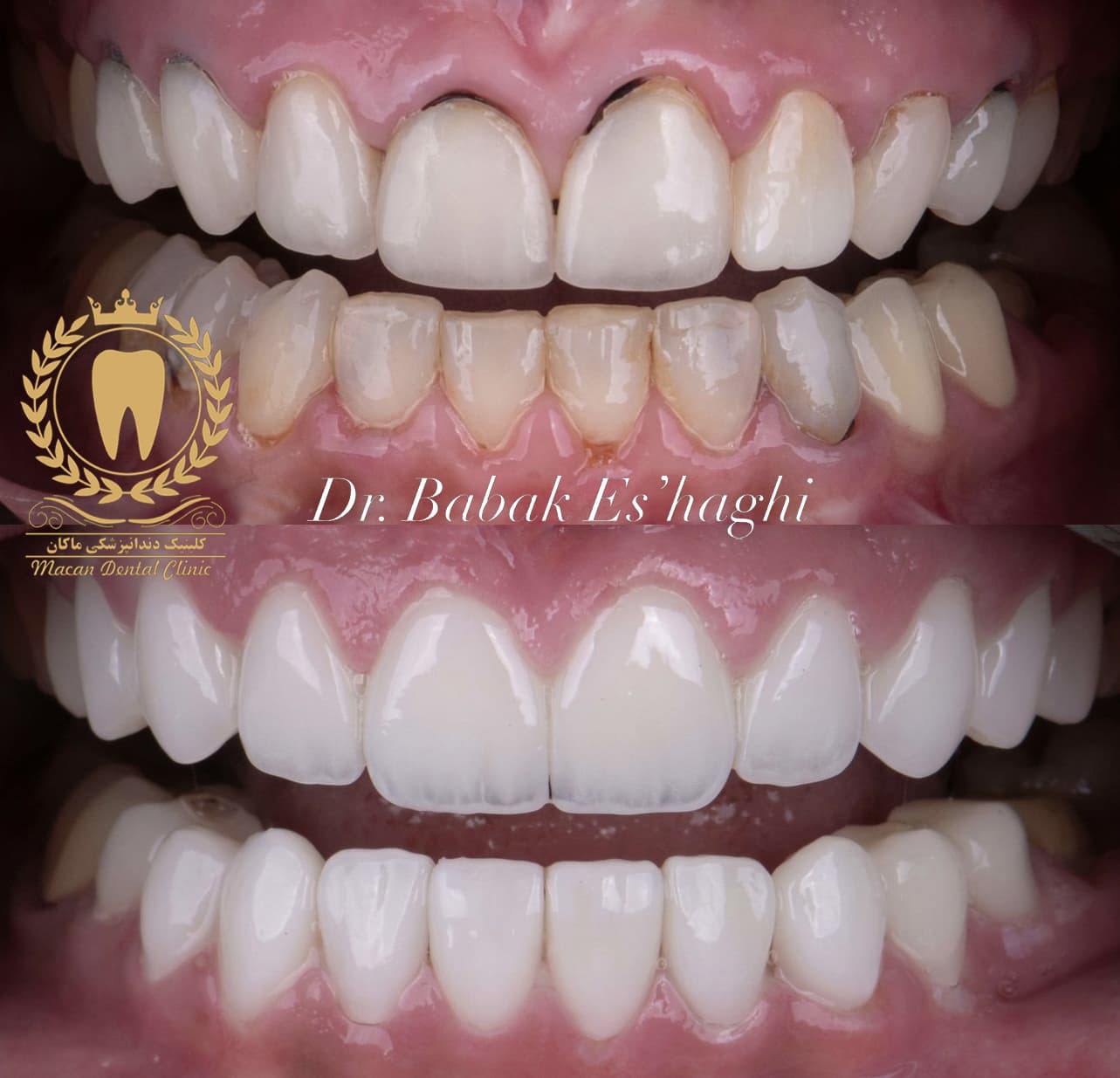 لمینت سرامیکی دندان لبه شفاف آلمانی IPS EMAX لمینت سرامیکی دندان لبه شفاف آلمانی IPS EMAX
