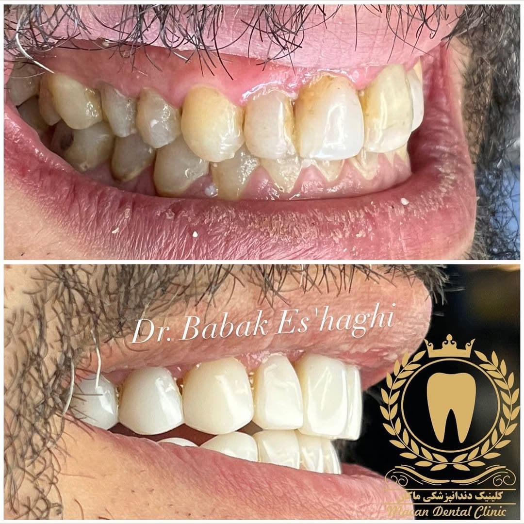 اجرای ونیر کامپوزیت Ultradent اجرای ونیر کامپوزیت Ultradent
