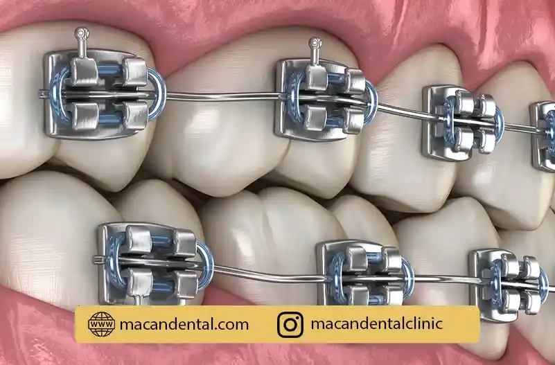 ارتودنسی با سیم و براکت: لبخندی زیبا و دندانهای مرتب