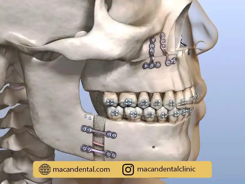جراحی ارتوگناتیک: اصلاح ناهنجاریهای فکی و زیبایی صورت
