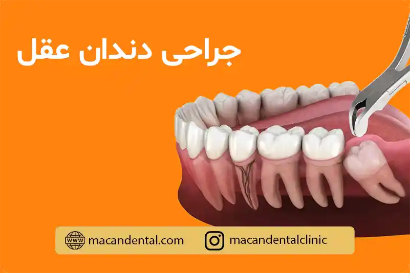 جراحی دندان عقل: هر آنچه که باید بدانید