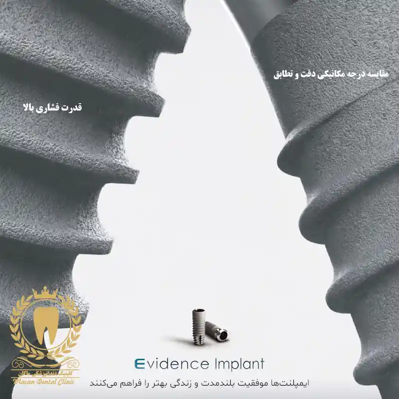 ایمپلنت اویدنس + بررسی کامل کیفیت، دوام و قیمت