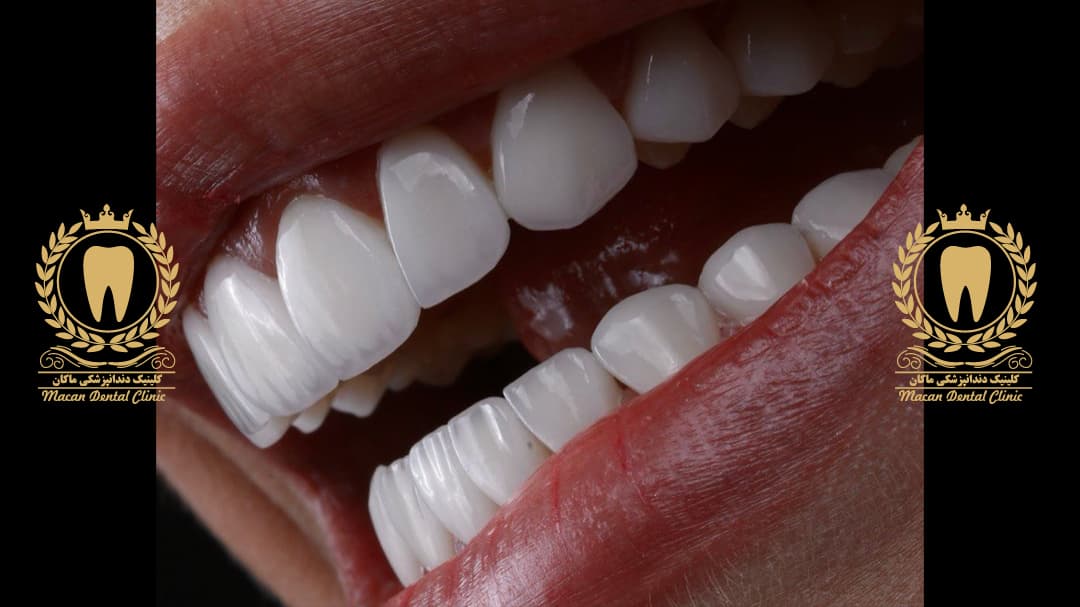 لمینت سرامیکی لبه شفاف درجه یک آلمانی لمینت سرامیکی لبه شفاف درجه یک آلمانی
