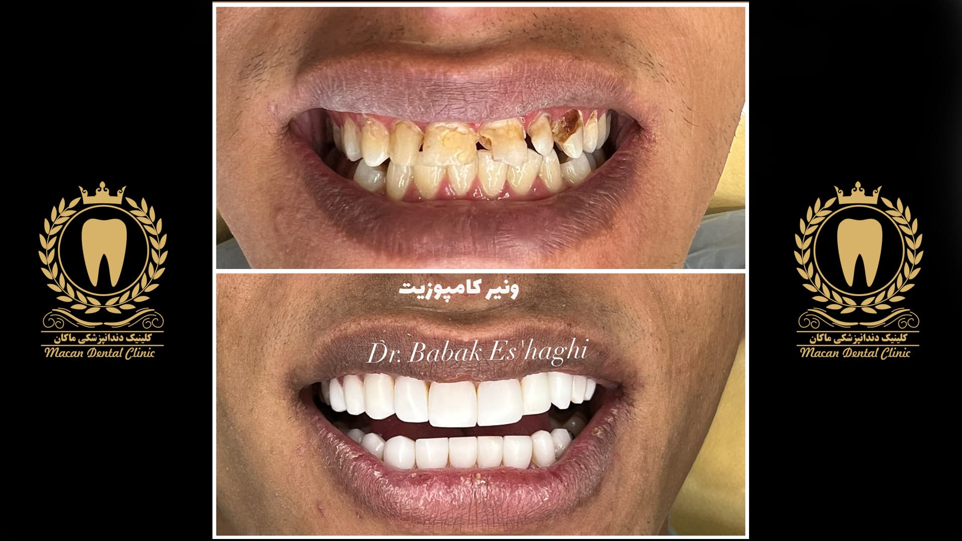 لمینت کامپوزیت دو فک کامل لمینت کامپوزیت دو فک کامل